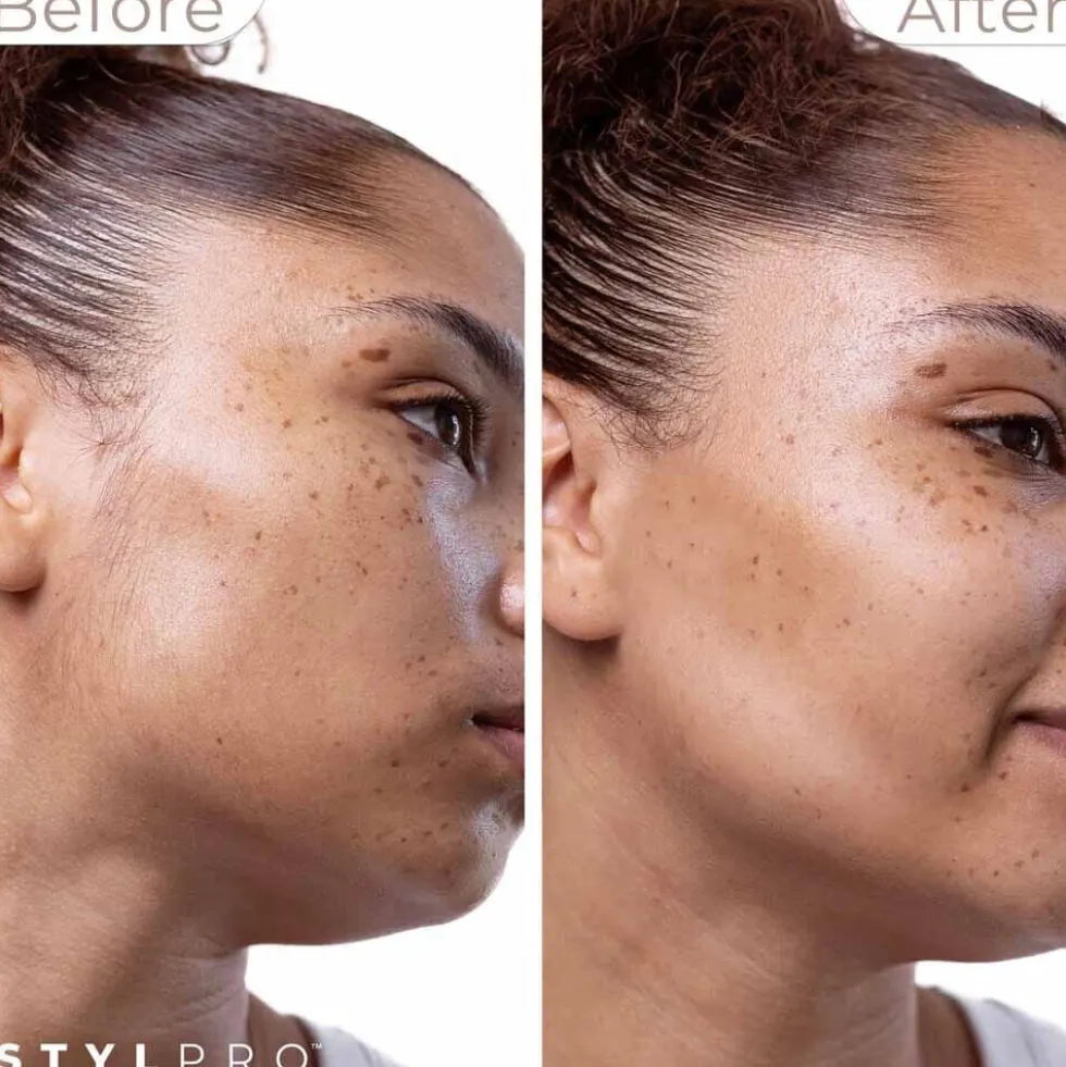 StylPro 2-in-1 Sonic Dermaplane